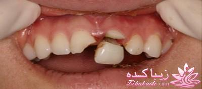 فوریتهای دندانپزشکی در کودکان چیست؟
